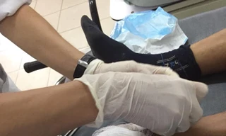 Nam công nhân đến bệnh viện cấp cứu trong tình trạng cây xà beng đâm xuyên thủng bàn chân.