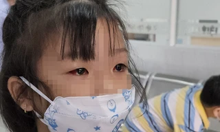 Đau mắt đỏ bùng phát, trường học ở TP.HCM cấp tốc phòng dịch