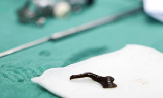 Ho ra máu, bé trai nhập viện mới phát hiện vắt bám trong đường thở