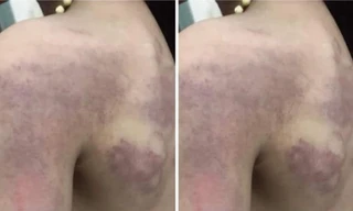 Tạm đình chỉ cô giáo đánh học trò bầm tím lưng