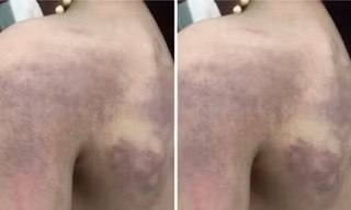 Tạm đình chỉ cô giáo đánh học trò bầm tím lưng