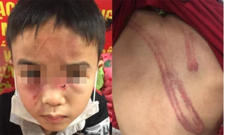 Hình ảnh cháu bé bị đánh chia sẻ trên mạng xã hội.