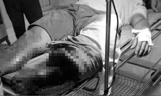 Một thanh niên bị chém đứt rời chân khi tham gia hỗn chiến