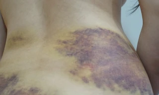 Vết thương trên cơ thể chị Sang. 