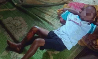 Khởi tố nam thanh niên đốt chân bé trai 8 tuổi 