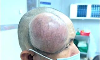 Phẫu thuật thành công khối u to như cái chén ở đầu bệnh nhân