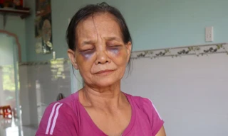 Phạt 2 triệu đồng con dâu đánh mẹ chồng tím mặt ở Bình Phước