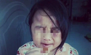 Cha về quê, con bị cô và dượng đánh đập tàn bạo