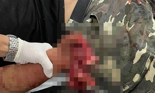 Nam thanh niên bị pháo nổ dập nát bàn tay