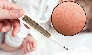 Ca mắc sởi tăng đột biến, một bệnh nhi ở Bình Dương tử vong