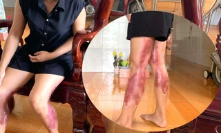 Một phụ nữ tố bị chồng cũ vác búa đuổi đánh, tạt nước sôi 