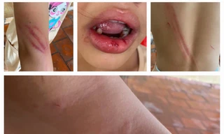 Bé gái 10 tuổi bị cha dượng đánh đập, người dân bức xúc báo công an