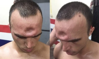 Jeremy bị lõm trán sau khi lĩnh trọn cú thúc cùi chỏ của đối thủ.