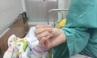 Mổ thành công cho nữ sinh cột sống ngoằn ngoèo như rắn lượn