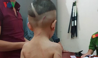 bé Lê Hoàng Huy với nhiều thương tích trên người
