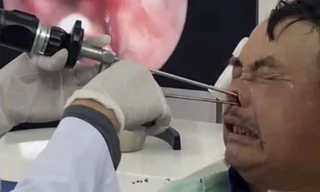 Gắp hơn 100 con giòi làm tổ trong mũi bệnh nhân