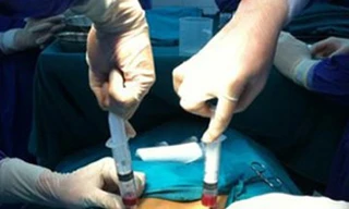 Chi tiền tỷ tiêm tế bào gốc để hồi xuân