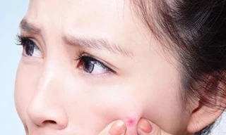 Khám miễn phí bệnh trứng cá