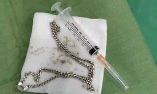 Bé 29 tháng tuổi nuốt sợi dây chuyền vào bụng