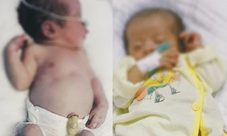 Chữa thành công bé sơ sinh nhiễm bệnh giang mai