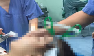 Nô đùa cùng bạn trong lớp, bé gái 10 tuổi bị kéo đâm sâu vào đầu