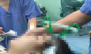 Nô đùa cùng bạn trong lớp, bé gái 10 tuổi bị kéo đâm sâu vào đầu