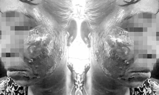 Chị H bị bỏng nặng ở vùng mặt và cổ. Ảnh: Báo Nghệ An