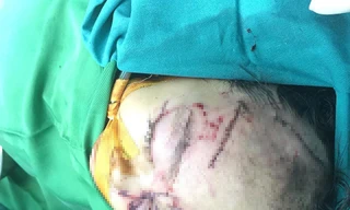 Bé Y. đang được điều trị tích cực tại bệnh viện. 