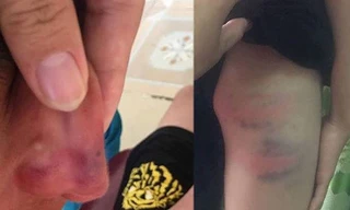 Giáo viên tiểu học khai nguyên nhân đánh con chồng nhập viện