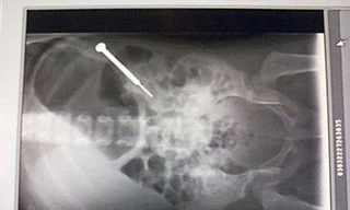 Bé gái 2 tuổi nuốt tua vít 9cm