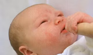 Bé bị chàm sữa do dính sữa mẹ?