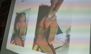 Quạt công nghiệp 'chém' nát mặt bé trai 6 tuổi