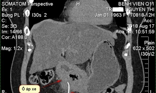 Bệnh nhân suýt chết vì xương cá dài 5cm đâm thủng dạ dày 