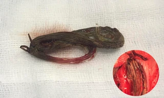 Lấy cuộn cước câu 'ở' trong niệu đạo nam thanh niên 11 năm