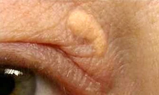 Nhìn mí mắt đoán nguy cơ đau tim