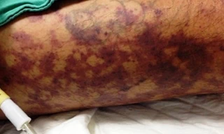 Mắc liên cầu lợn sau khi ăn bánh ướt thịt heo