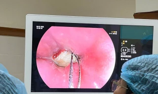 Nam thanh niên nhập viện cấp cứu vì nuốt xương heo