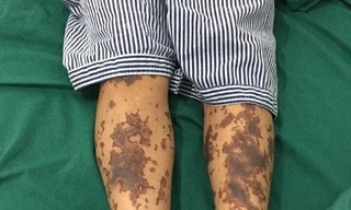 Huế: Xử lý khẩn khu vực có ca bệnh liên cầu khuẩn đầu tiên trong năm