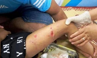 Bé trai 4 tuổi ra đường chơi bị chó dữ cắn phải nhập viện cấp cứu