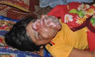 H’Loai với khuôn mặt dị dạng vì khối u