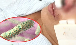 9 bệnh nhân mắc bệnh ‘vi khuẩn ăn thịt người’ Whitmore