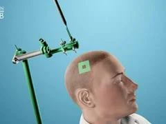 Sử dụng sóng siêu âm để chẩn đoán ung thư não