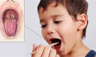 50% bệnh nhân bạch hầu không có triệu chứng