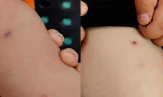 3 giáo viên mầm non bị tố dùng kim đâm trẻ