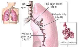 Hen phế quản có biến chứng thế nào?