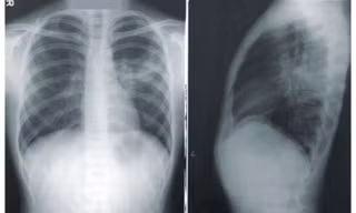 Tìm ra nguyên nhân vì sao nhiều người không bao giờ hút thuốc lá lại bị ung thư phổi