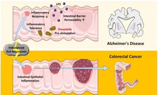 Người bị Alzheimer ít có nguy cơ mắc ung thư đại tràng và ngược lại, vì sao?