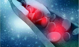 Lưu thông máu kém: Cách phát hiện và phòng ngừa