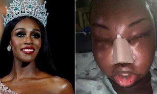 Sốc với khuôn mặt biến dạng vì thẩm mỹ của Hoa hậu chuyển giới quốc tế 2019