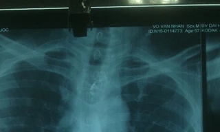 Hình X-quang kiểm tra thực quản sau phẫu thuật. Ảnh do bệnh viện cung cấp.